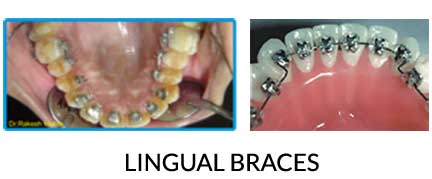 Invisible Braces service